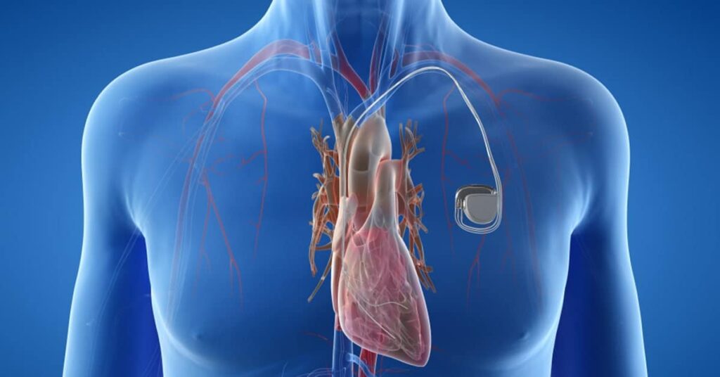 arritmia cardiaca - marca passo